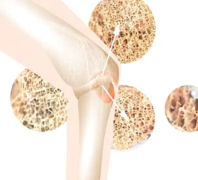 PEMF therapy supports bone health